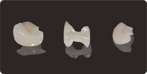 شراء دقة الأسنان المزروعات والملصقات الليثيوم Disilicate طحن Onlay veneer online manufacture