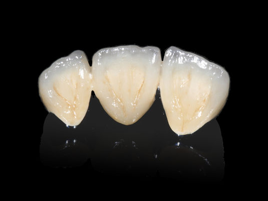 شراء زرع الأسنان PFM الجسر غير الثمين CAD CAM PFM التاج online manufacture