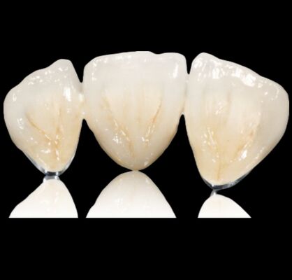 شراء تخصيص التاج شبه الثمين أو الجسر التاج والجسر online manufacture