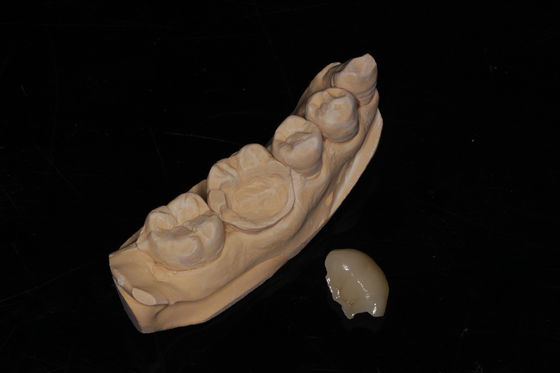 الأسنان المركبة Onlay Veneer جمالية عالية Composite Veneer