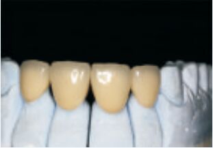 تاج و جسر من سبيكة النبيلة البيضاء الدقيقة و المخصصة